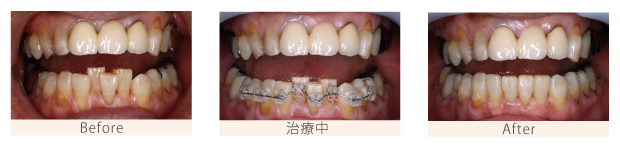 歯列矯正の治療前後