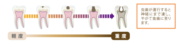 虫歯が進行すると神経にまで達し、やがて抜歯に至ります。