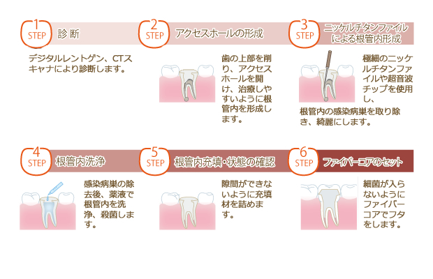 根管治療の流れ。診断、アクセスホールの形成、ニッケルチタンファイルによる根管内形成、根管内洗浄、根管内充填・状態の確認、ファイバーコアのセットの流れで治療を行います。