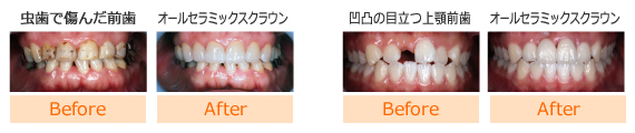 虫歯で痛んだ前歯をオールセラミックスクラウンで治療した写真。凹凸の目立つ上顎前歯をオールセラミックスクラウンで治療した写真。